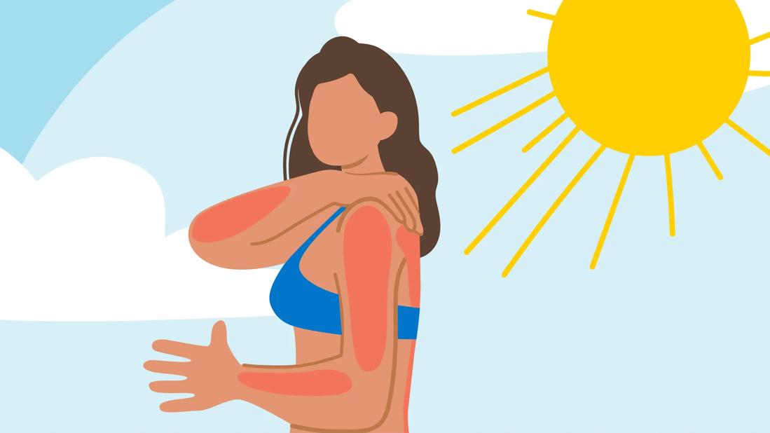 Person with a bad sunburn on parts of their body while at the beach