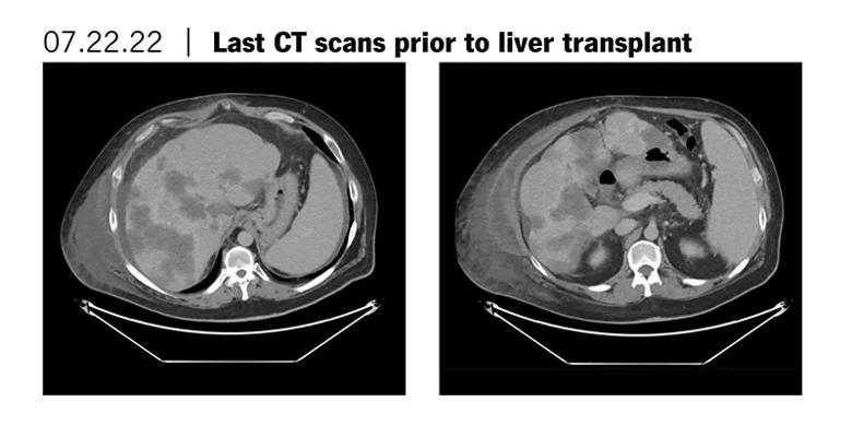 Last scan prior to liver transplant